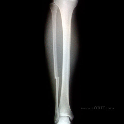 fibula fracture xray Fibular shaft fracture xray