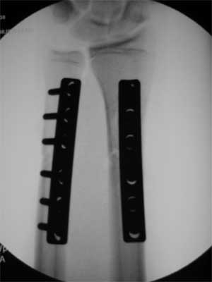 radius and ulnar shaft fracture ORIF xray