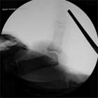 thumb UCL rupture xray thumb UCL rupture xray