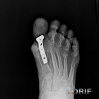 hallux MTP fusion hallux MTP fusion
