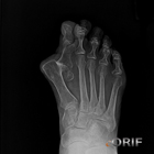 hallux valgus dislocation xray hallux valgus dislocation xray
