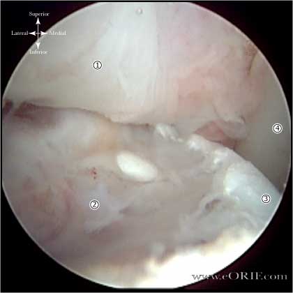 Hill-Sachs Lesion arthroscopic picture