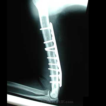 humeral shaft fracture ORIF xray