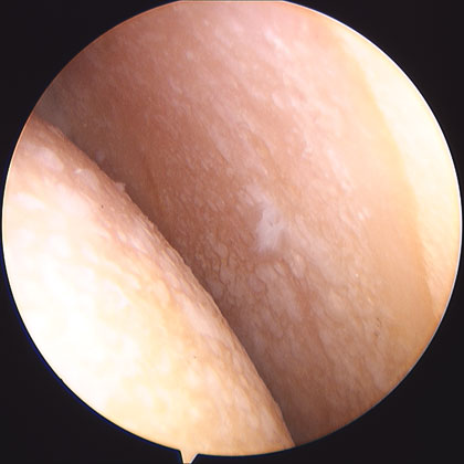 Arthroscopic image of glenohumeral arthritis