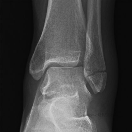 Lateral malleolus fracture xray Lateral malleolus fracture xray