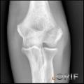 lateral condyle humerus fracture