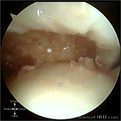 Patellar Dislocation Images patellar dislocation picture