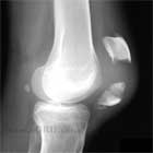 Patella fracture xray Displaced patella fracture lateral view xray