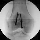 ORIF patellar fracture xray ORIF patella fracture A/P xray