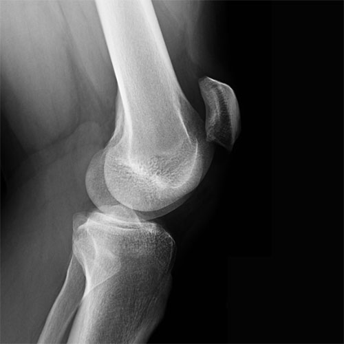patellar alta picture patellar alta xray
