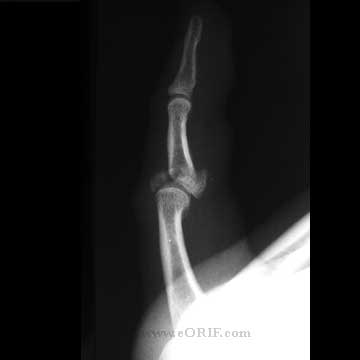 PIP joint pilone fracture xray