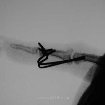 PIP Ex Fix xray PIP external fixation xray