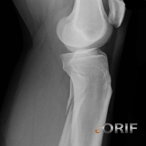 proximal fibula fracture massonuei proximal fibular fracture