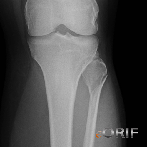 proximal fibular fracture proximal fibula fracture