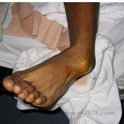 Subtalar dislocation image Subtalar dislocation clinical photo