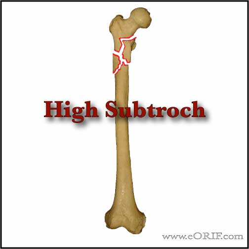 high subtroch femur fracture picture high subtroch femur fracture picture