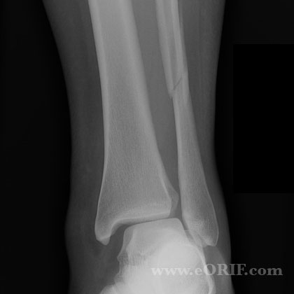 Lateral malleolus fracture xray Lateral malleolus fracture syndesmosis injury xray