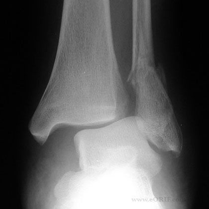 Ankle syndesmosis injury xray