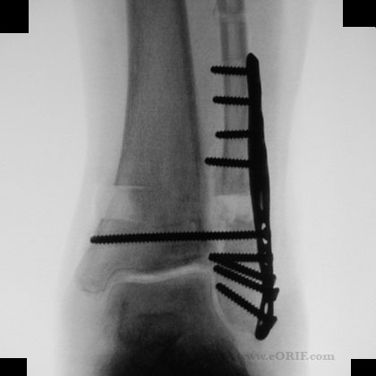 Ankle syndesmosis fixation xray Ankle syndesmosis fixation xray