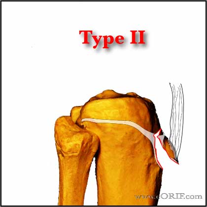 Tibial Tubercle Avlusion Fracture Type II