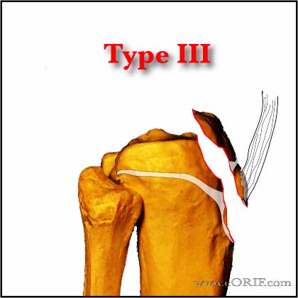 Tibial Tubercle Avlusion Fracture Type III