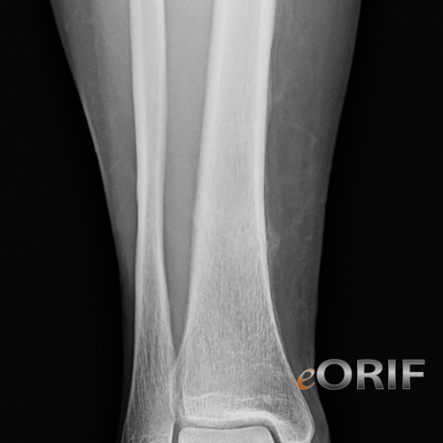 tibial shaft stress fracture xray tibial shaft stress fracture xray