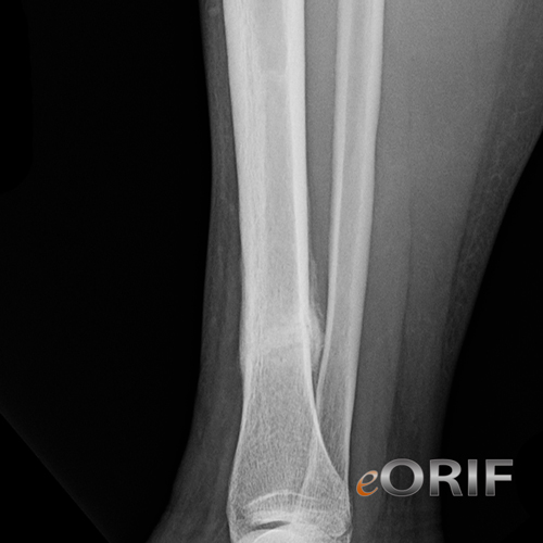 tibial shaft stress fracture xray tibial shaft stress fracture xray