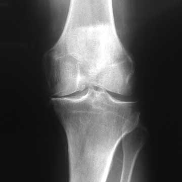 knee arthritis xray knee arthritis xray