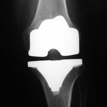 total knee replacement xray total knee replacement xray