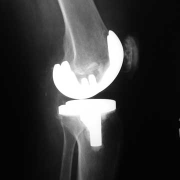 total knee replacement xray