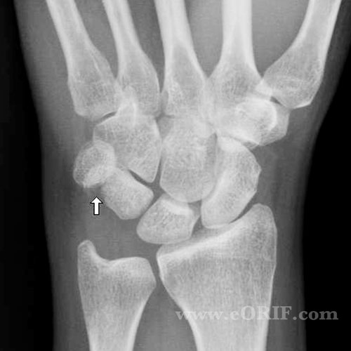 Triquetrum Fracture xray triquetrum fracture xray