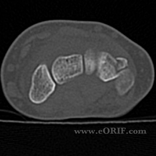 Triquetrum Fracture MRI Triquetrum fracture MRI