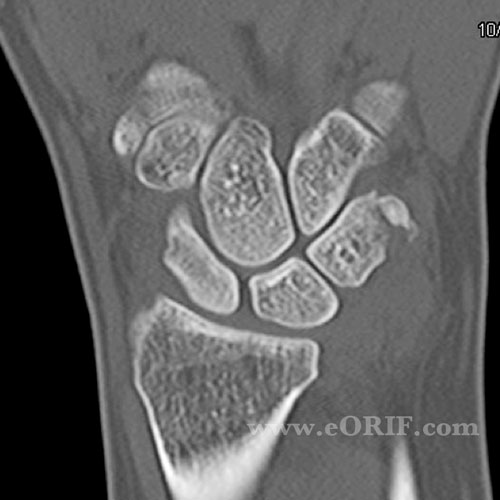 Triquetral fracture MRI Triquetral fracture MRI