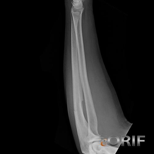 ulnar shaft fracture ulnar shaft fracture