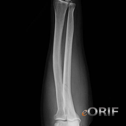 proximal ulnar shaft fracture xray proximal ulnar shaft fracture xray