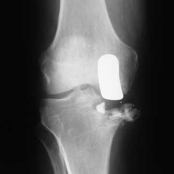 failed unicompartment knee arthroplasty failed unicompartment knee arthroplasty