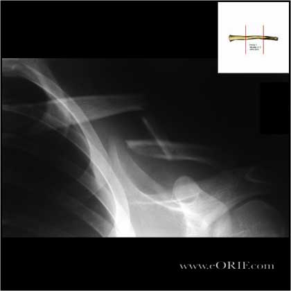 Type I Clavicle shaft fracture xray
