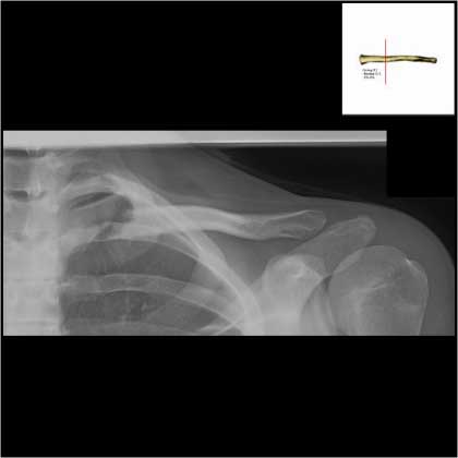 Medial clavicle fracture xray
