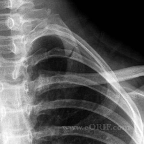 1st rib fracture xray