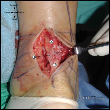 Achilles tendon rupture approach