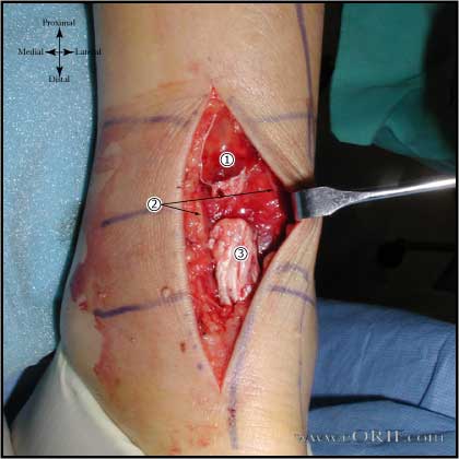 Achilles tendon rupture image