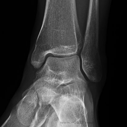 Ankle Mortise View xray