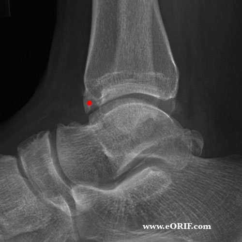 Anterior ankle impingement lateral view xray