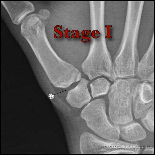 Thumb CMC arthritis Stage I xray