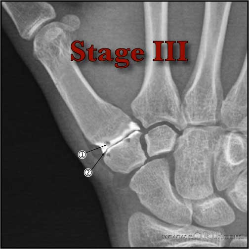 Thumb CMC osteoarthritis stage III xray