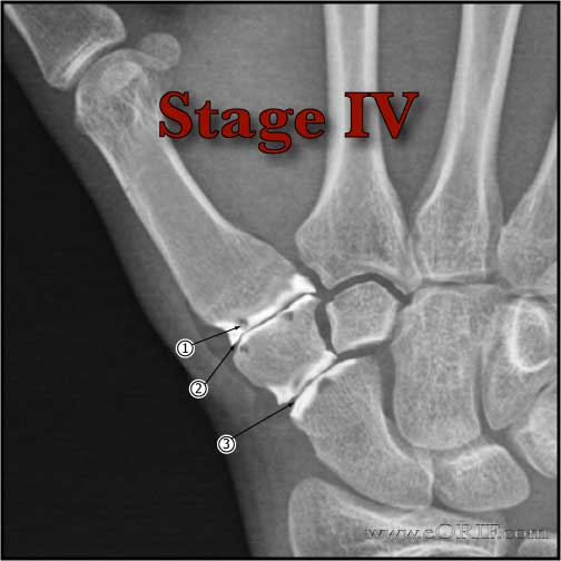 Thumb CMC osteoarthritis stage IV xray