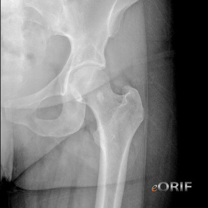 Bone Island (exostosis) X-ray 