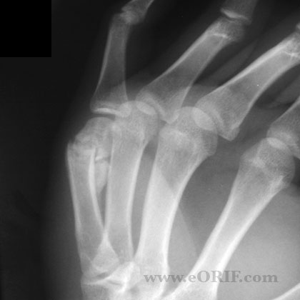 Boxers Fracture malunion xray