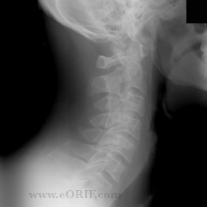 Cervical spine lateral view