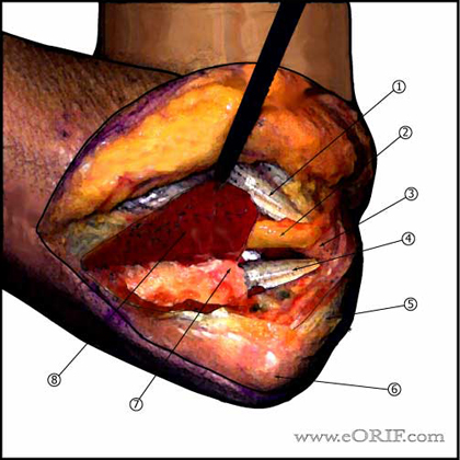 Posteromedial approach to the elbow